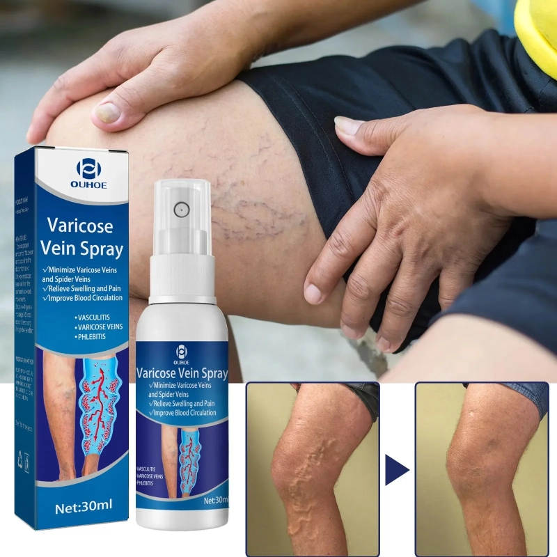 Varicose vein spray